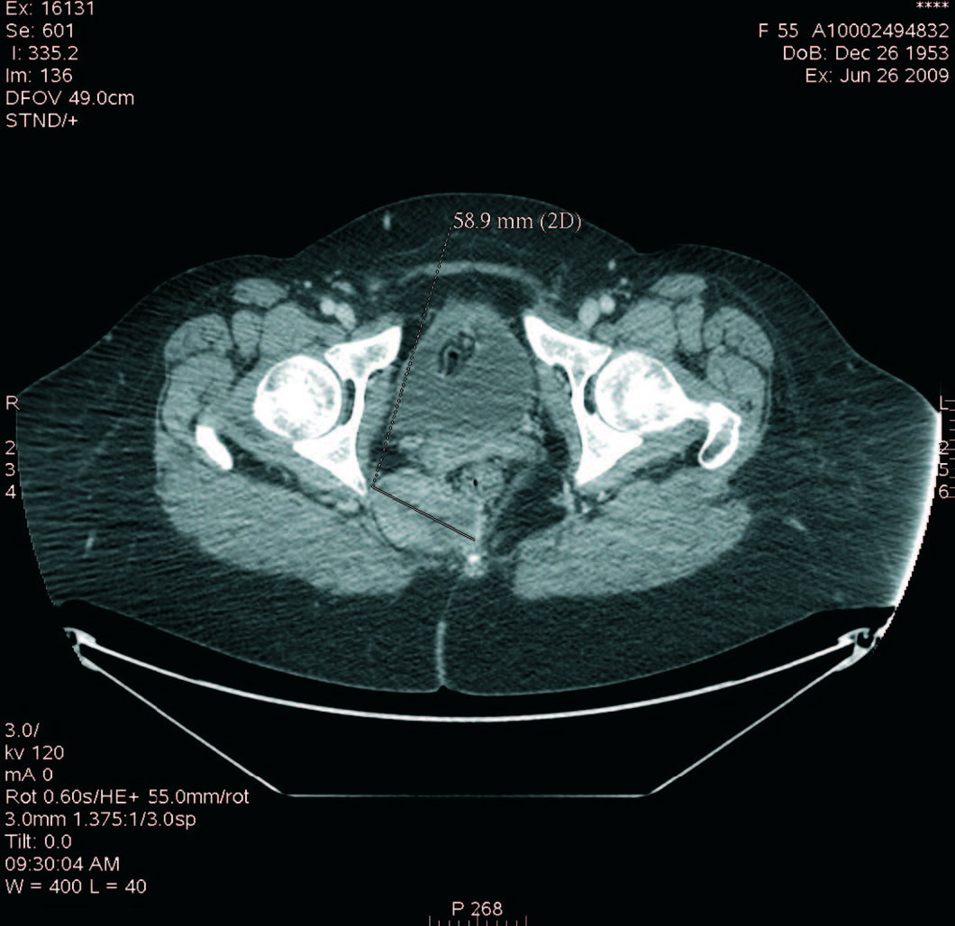 Lire la suite à propos de l’article Management of Complications of Prosthetic Mid-urethral Tape Surgery for Stress Urinary Incontinence in Women
